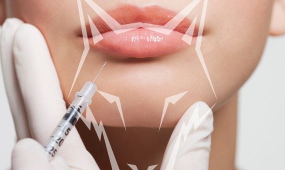 botox inserted to lower lip